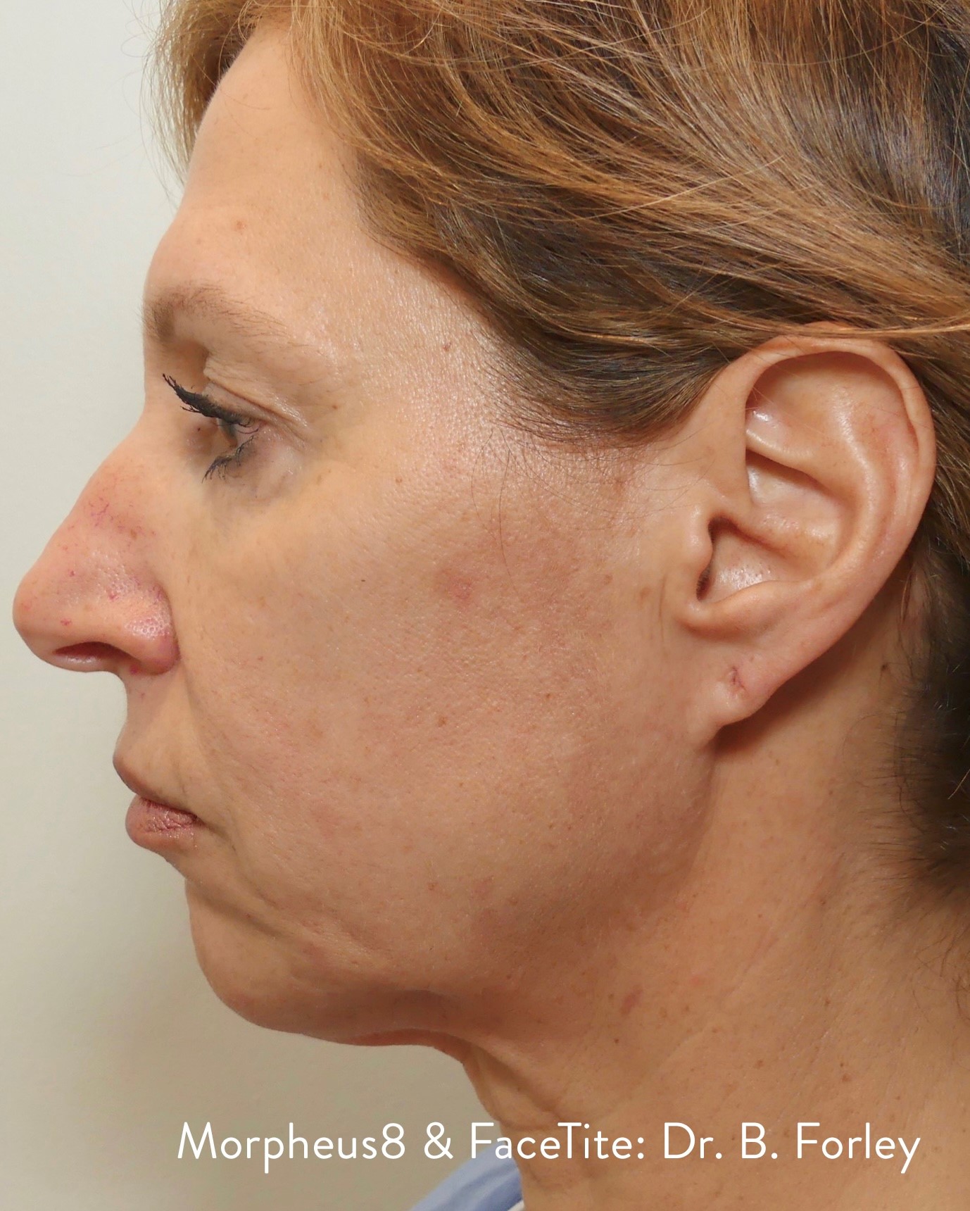 After-facefour