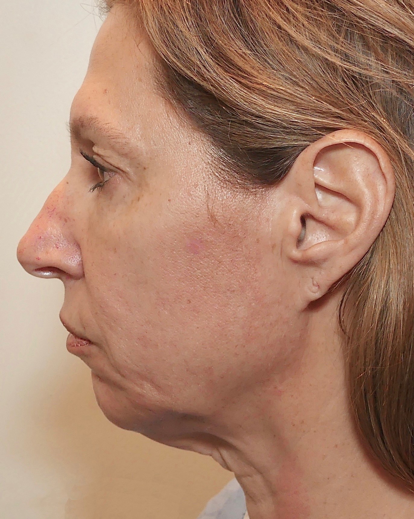 Before-facefour