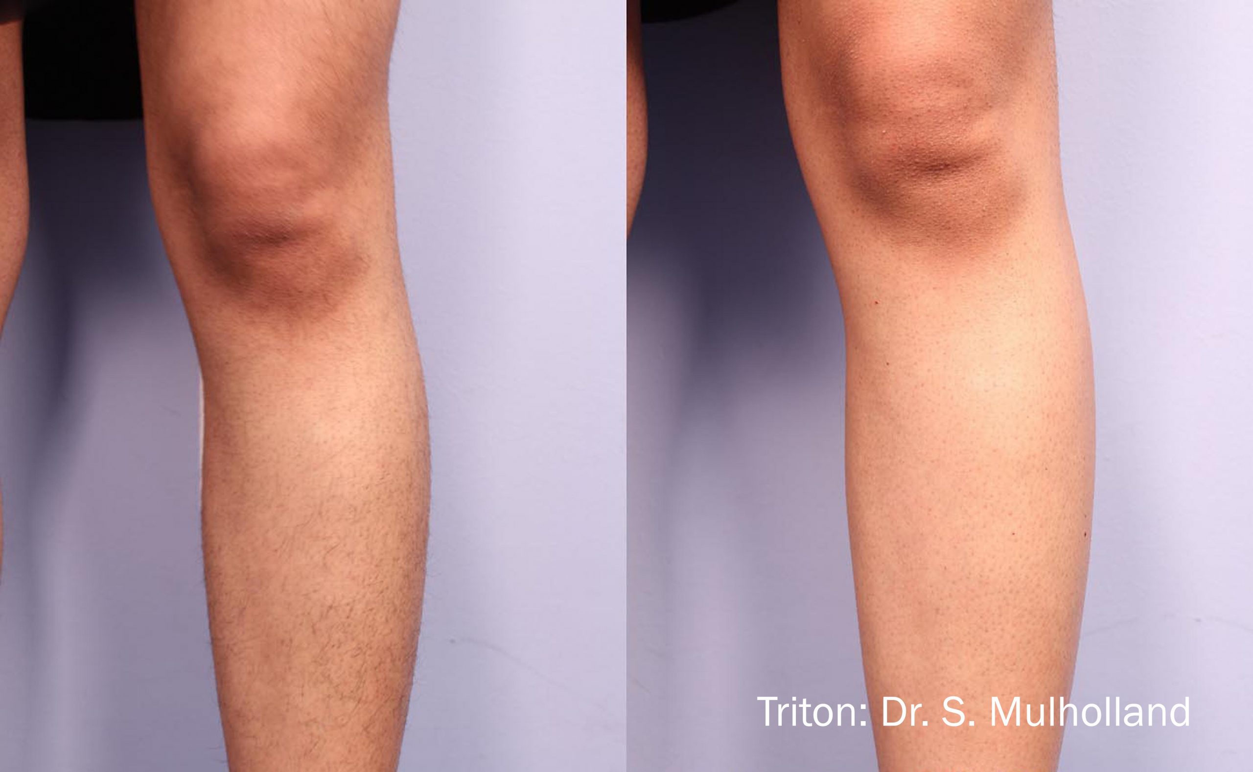 A man with no visible knee and without knee surgery.